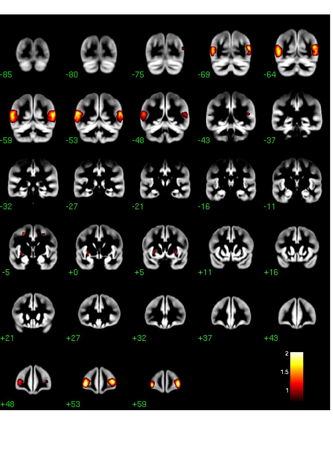 Coronal results